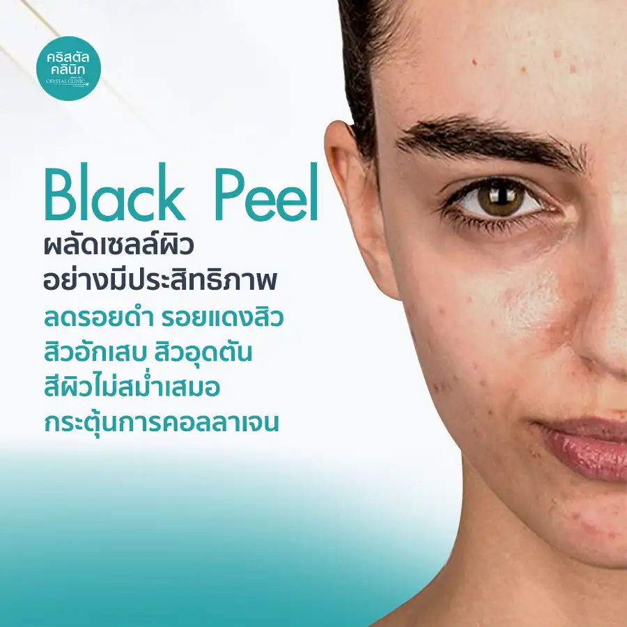 Black Peel ผลัดเซลล์ผิวอย่างมีประสิทธิภาพ ลดรอยดำ รอยแดงสิว สิวอักเสบ สิวอุดตัน สีผิวไม่สม่ำเสมอ