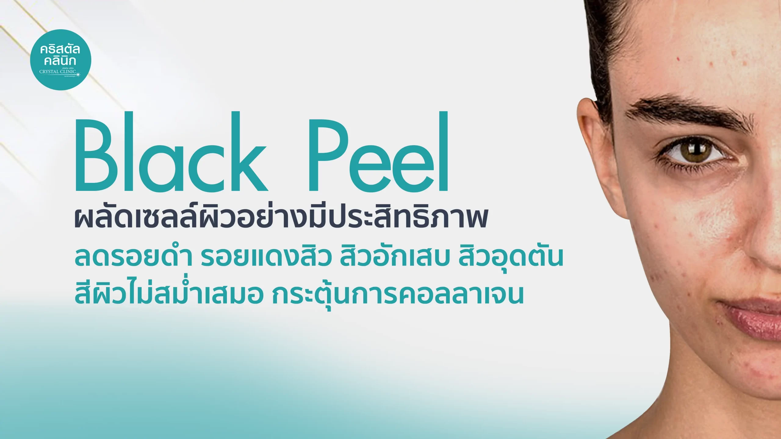Black Peel ผลัดเซลล์ผิวอย่างมีประสิทธิภาพ ลดรอยดำ รอยแดงสิว สิวอักเสบ สิวอุดตัน สีผิวไม่สม่ำเสมอ Black Peel ผลัดเซลล์ผิวอย่างมีประสิทธิภาพ ลดรอยดำ รอยแดงสิว สิวอักเสบ สิวอุดตัน สีผิวไม่สม่ำเสมอ