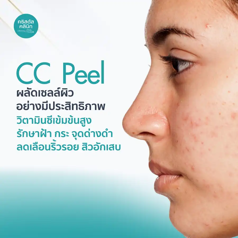 CC Peel ผลัดเซลล์ผิว ด้วยวิตามินเข้มข้นสูง รักษาฝ้า กระ จุดด่างดำ ลดเลือดริ้วรอย สิวอักเสบ สิวหัวช้าง สิวอุดตัน
