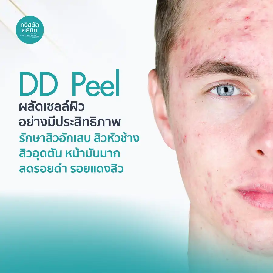 DD Peel ผลัดเซลล์ผิว รักษาสิวอักเสบ สิวหัวช้าง สิวอุดตัน หน้ามันมาก ลดรอยดำ รอยแดงจากสิว