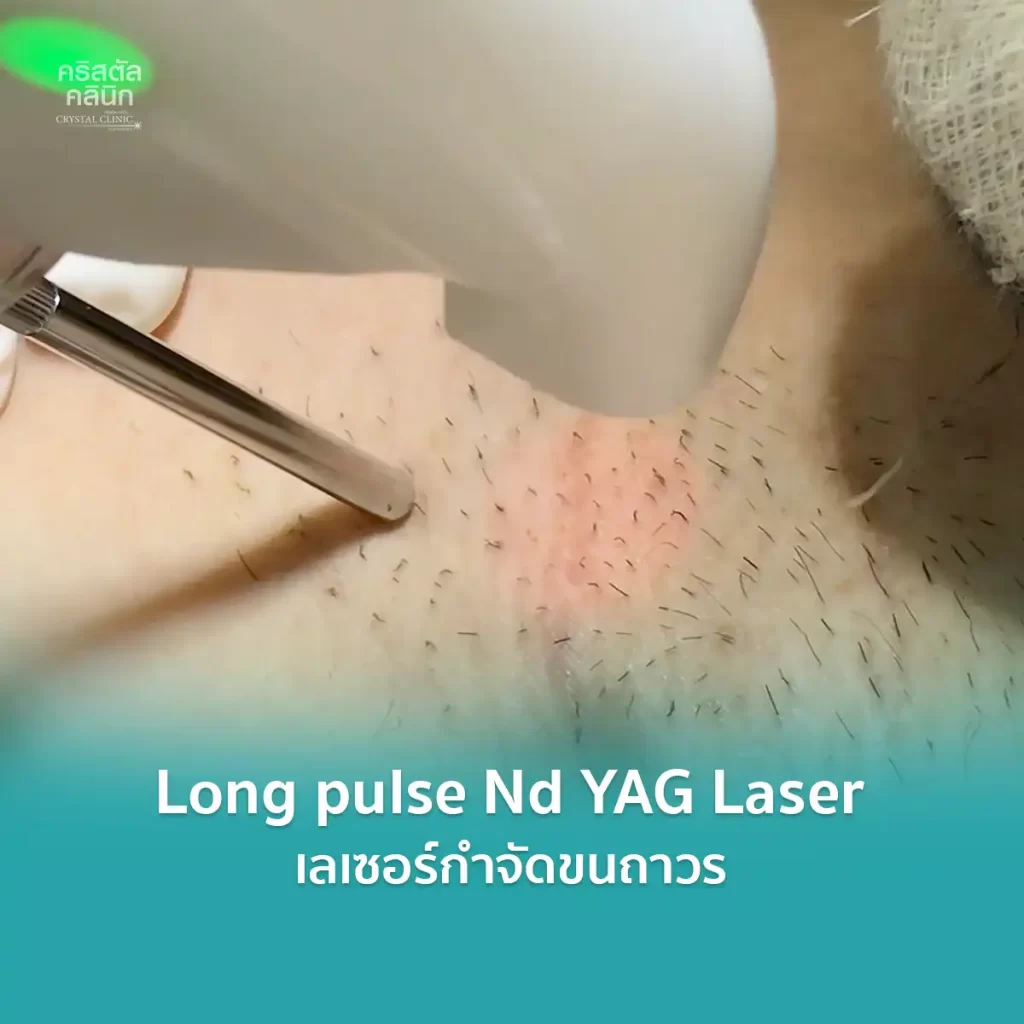 Long pulse nd yag laser เลเซอร์กำจัดขนถาวร