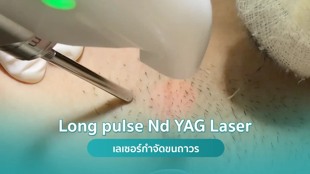 Long Pulse Nd YAG Laser เลเซอร์กำจัดขนถาวร คริสตัลคลินิก มหาสารคาม Long Pulse Nd YAG Laser เลเซอร์กำจัดขนถาวร คริสตัลคลินิก มหาสารคาม
