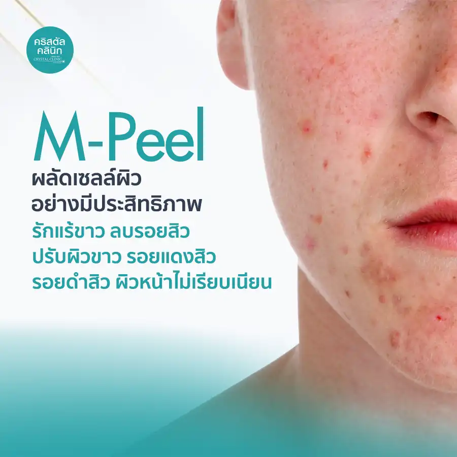 M-Peel ผลัดเซลล์ผิวอย่างมีประสิทธิภาพ รักแร้ขาว ลบรอยสิว ปรับผิวขาว รอยแดงสิว รอยดำสิว ผิวหน้าไม่เรียบเนียน