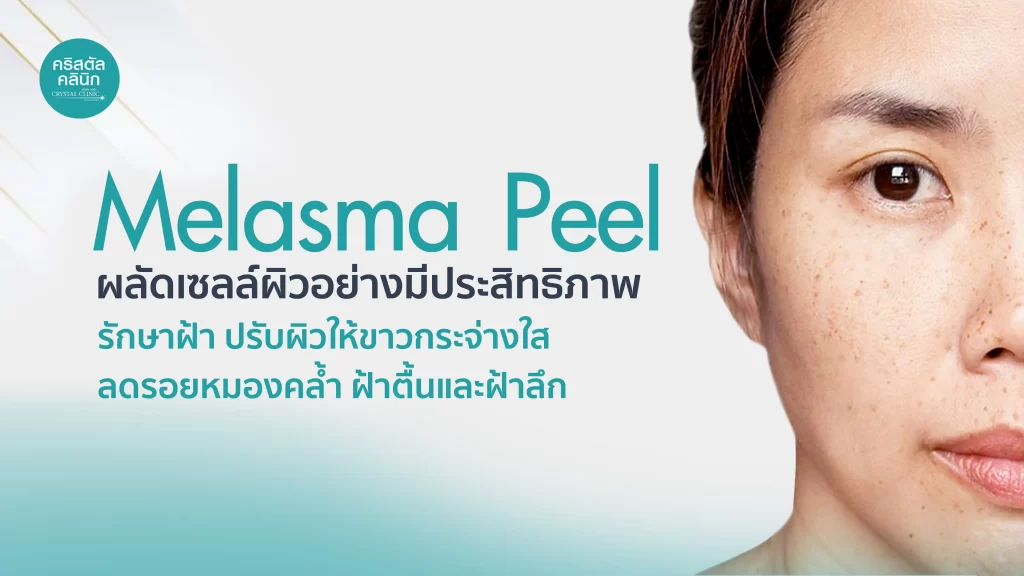 Melasma Peel รักษาฝ้า ปรับผิวให้ขาวกระจ่างใส รอยหมองคล้ำ รอยดำและรอยแดง ฝ้าตื้นและฝ้าลึก Melasma Peel รักษาฝ้า ปรับผิวให้ขาวกระจ่างใส รอยหมองคล้ำ รอยดำและรอยแดง ฝ้าตื้นและฝ้าลึก