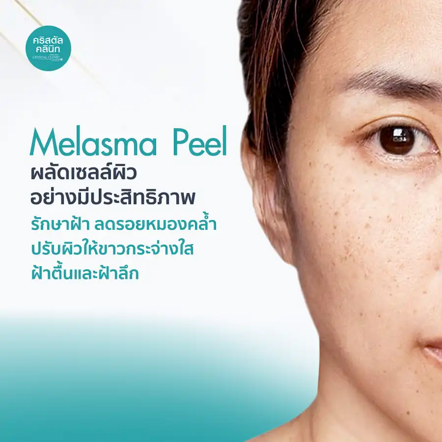 Melasma Peel รักษาฝ้า ปรับผิวให้ขาวกระจ่างใส รอยหมองคล้ำ รอยดำและรอยแดง ฝ้าตื้นและฝ้าลึก