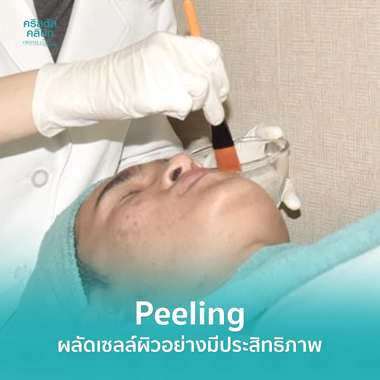Peeling ผลัดเซลล์ผิวอย่างมีประสิทธิภาพ คริสตัลคลินิก มหาสารคาม