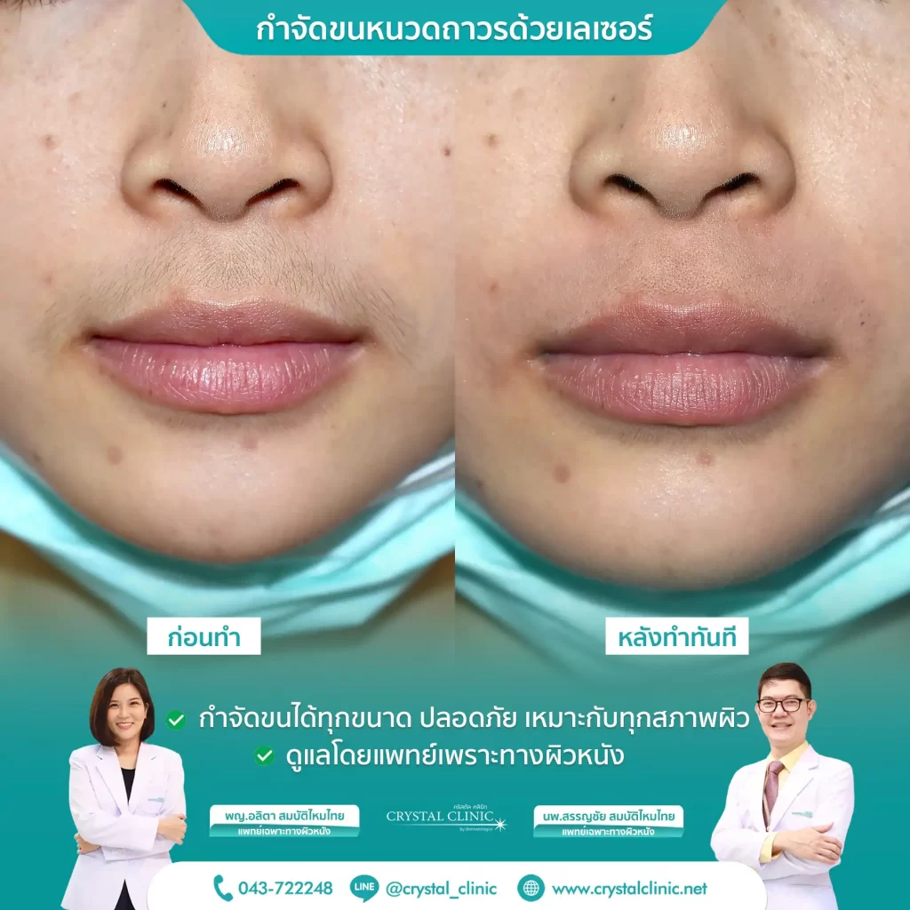 เคสรีวิวกำจัดขนหนวด ด้วยเลเซอร์ Long pulse nd yag laser เลเซอร์กำจัดขนถาวร คริสตัลคลินิก มหาสารคาม เคสรีวิวกำจัดขนหนวด ด้วยเลเซอร์ Long pulse nd yag laser เลเซอร์กำจัดขนถาวร คริสตัลคลินิก มหาสารคาม