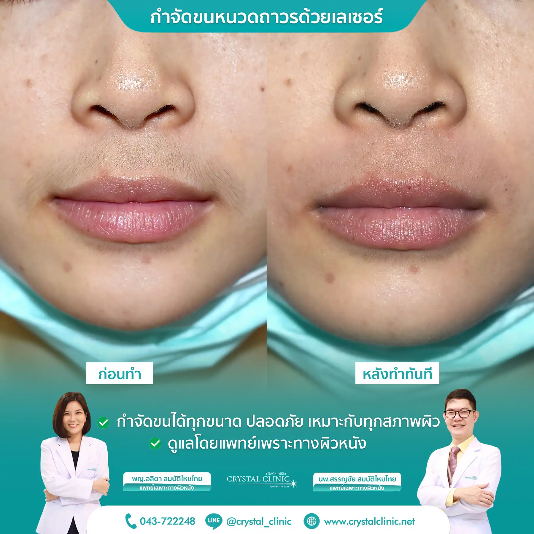 เคสรีวิวกำจัดขนหนวด ด้วยเลเซอร์ Long pulse nd yag laser เลเซอร์กำจัดขนถาวร คริสตัลคลินิก มหาสารคาม