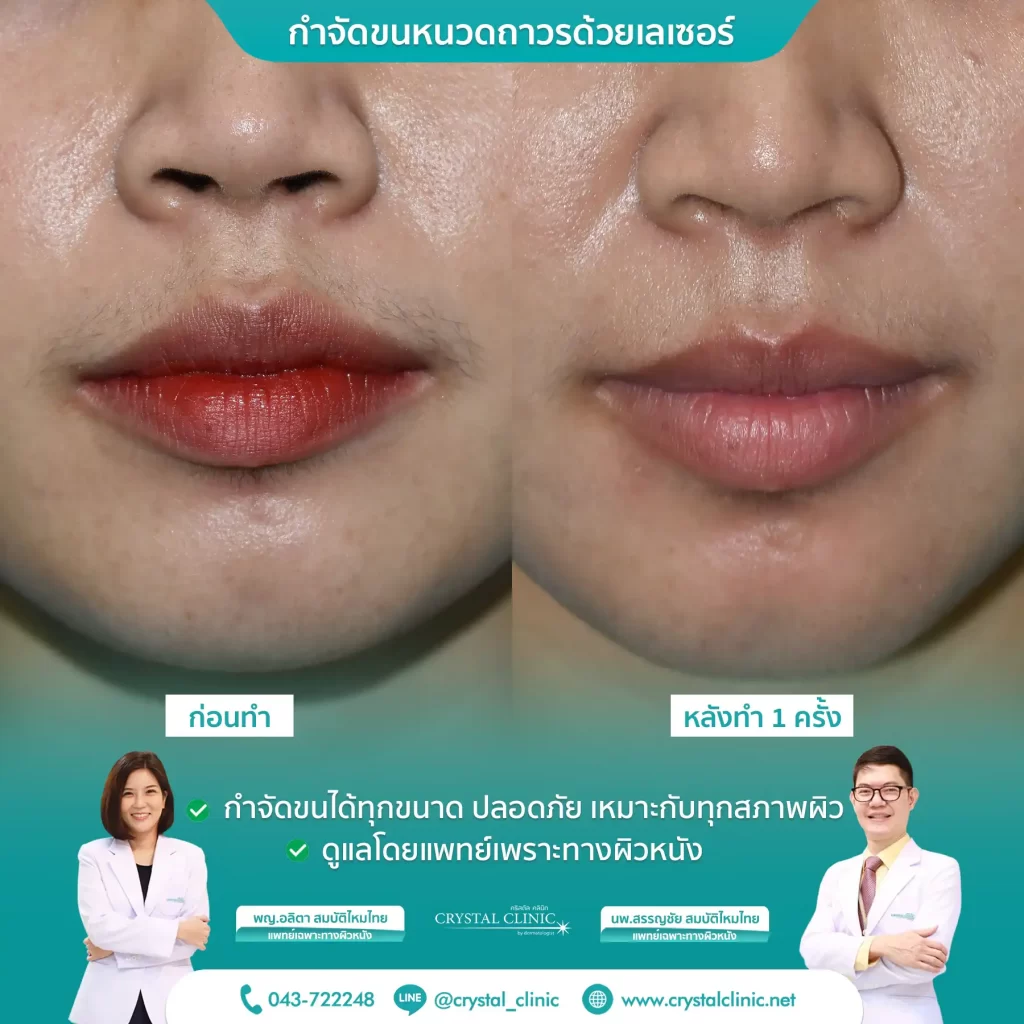 เคสรีวิวกำจัดขนหนวด ด้วยเลเซอร์ Long pulse nd yag laser เลเซอร์กำจัดขนถาวร คริสตัลคลินิก มหาสารคาม เคสรีวิวกำจัดขนหนวด ด้วยเลเซอร์ Long pulse nd yag laser เลเซอร์กำจัดขนถาวร คริสตัลคลินิก มหาสารคาม