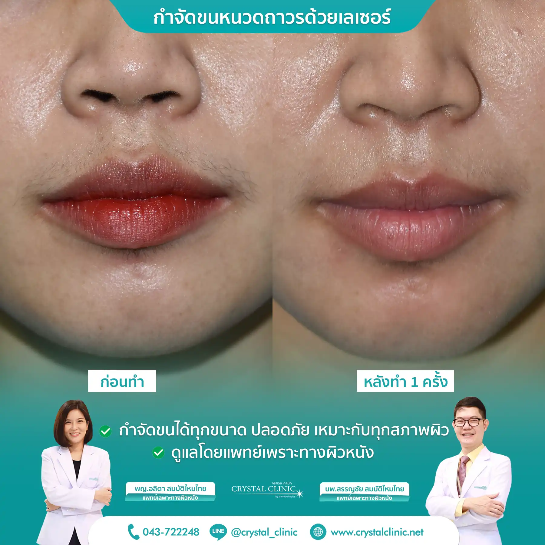 เคสรีวิวกำจัดขนหนวด ด้วยเลเซอร์ Long pulse nd yag laser เลเซอร์กำจัดขนถาวร คริสตัลคลินิก มหาสารคาม