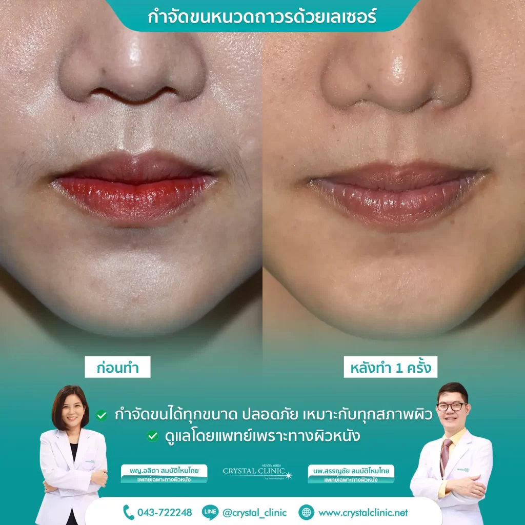 เคสรีวิวกำจัดขนหนวด ด้วยเลเซอร์ Long pulse nd yag laser เลเซอร์กำจัดขนถาวร คริสตัลคลินิก มหาสารคาม เคสรีวิวกำจัดขนหนวด ด้วยเลเซอร์ Long pulse nd yag laser เลเซอร์กำจัดขนถาวร คริสตัลคลินิก มหาสารคาม