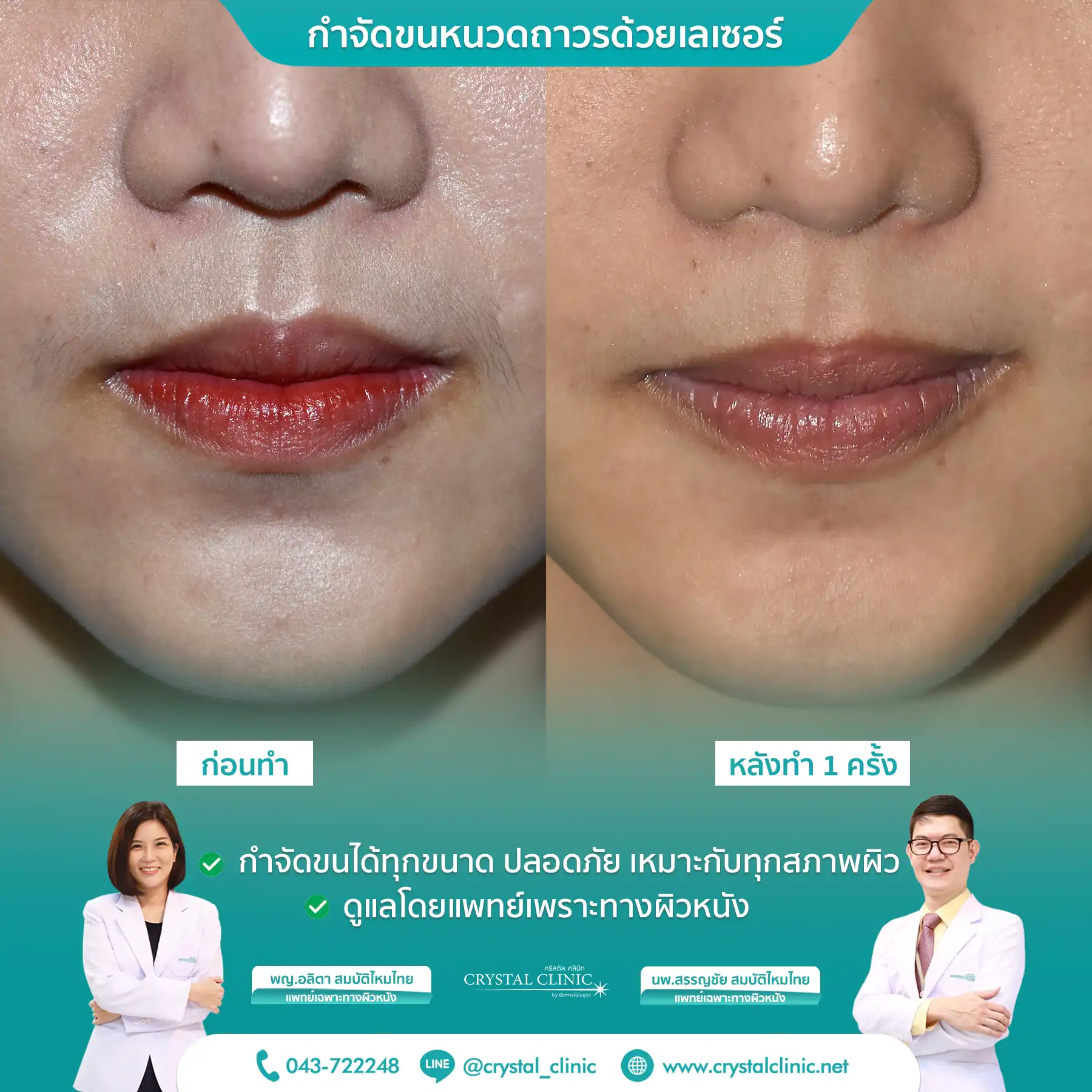 เคสรีวิวกำจัดขนหนวด ด้วยเลเซอร์ Long pulse nd yag laser เลเซอร์กำจัดขนถาวร คริสตัลคลินิก มหาสารคาม