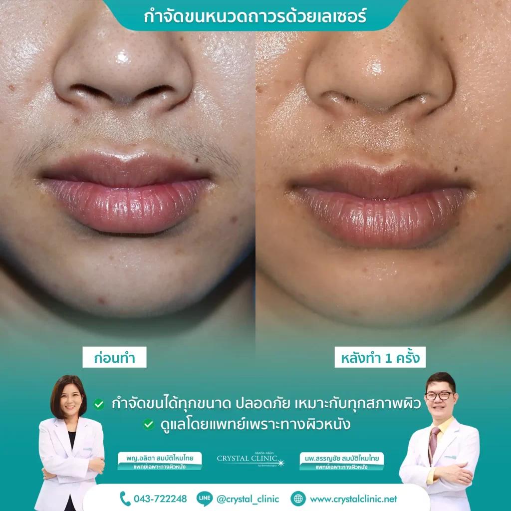 เคสรีวิวกำจัดขนหนวด ด้วยเลเซอร์ Long pulse nd yag laser เลเซอร์กำจัดขนถาวร คริสตัลคลินิก มหาสารคาม เคสรีวิวกำจัดขนหนวด ด้วยเลเซอร์ Long pulse nd yag laser เลเซอร์กำจัดขนถาวร คริสตัลคลินิก มหาสารคาม