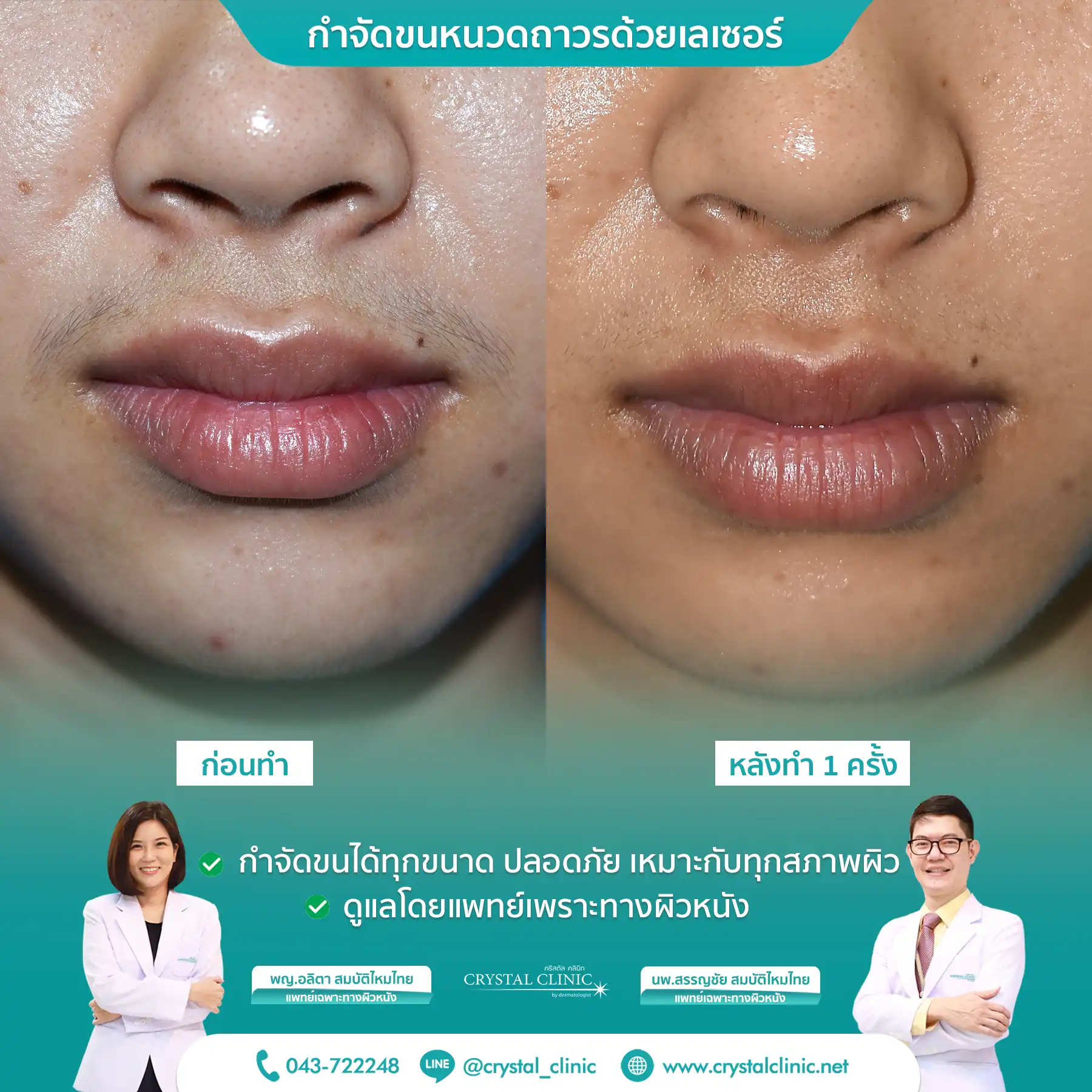 เคสรีวิวกำจัดขนหนวดด้วยเลเซอร์ Long pulse nd yag laser เลเซอร์กำจัดขนถาวร คริสตัลคลินิก มหาสารคาม