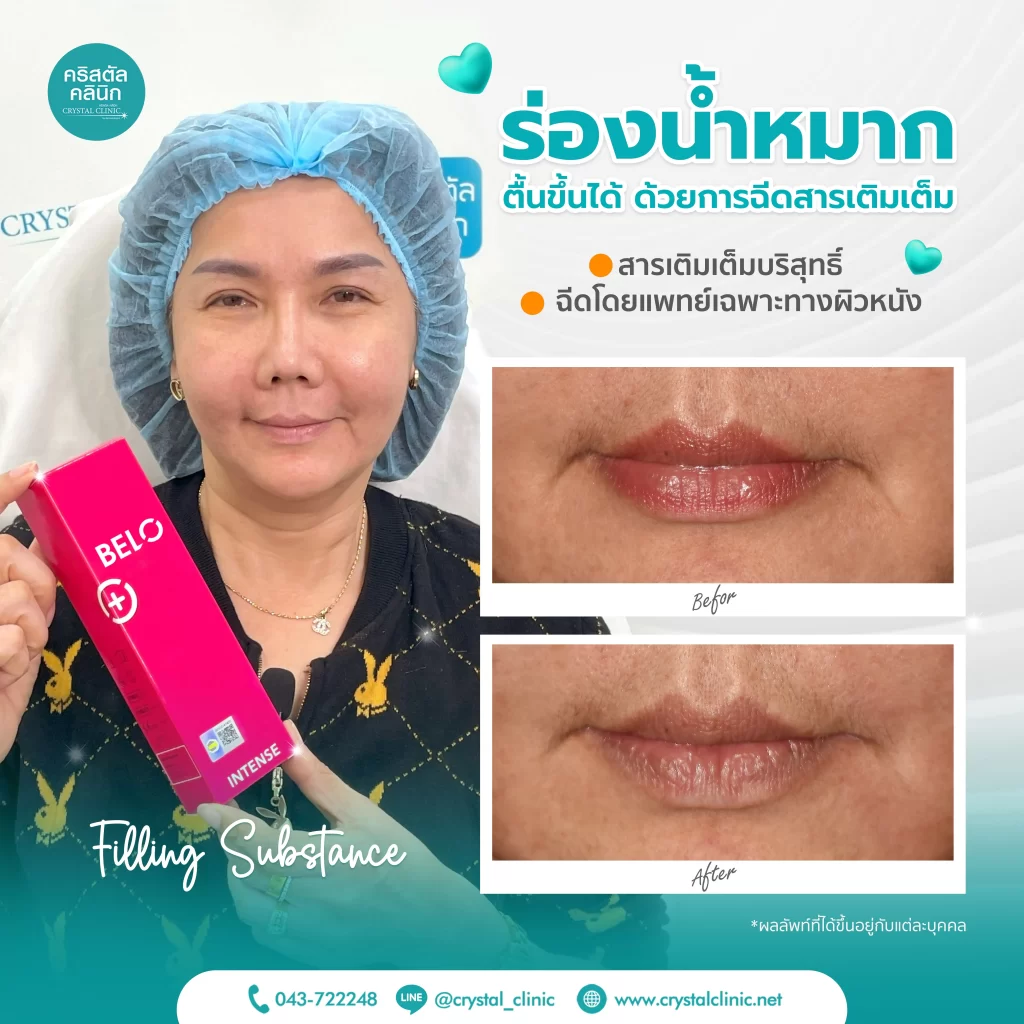 เคสรีวิวฉีดฟิลเลอร์ร่องน้ำหมาก Belotero คริสตัลคลินิก มหาสารคาม เคสรีวิวฉีดฟิลเลอร์ร่องน้ำหมาก Belotero คริสตัลคลินิก มหาสารคาม