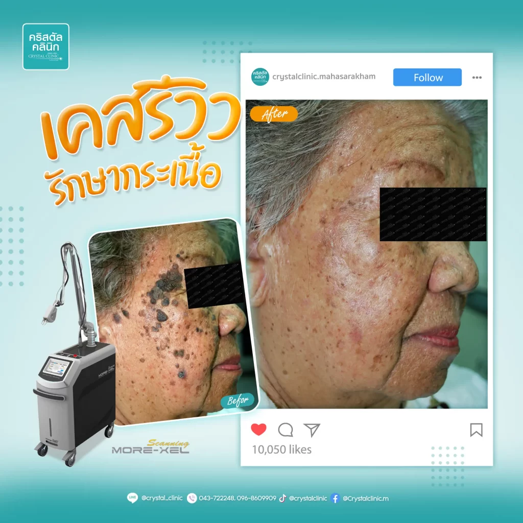 รีวิวเคสรักษากระเนื้อ-คริสตัลคลินิก มหาสารคาม CO2 Laser กระเนื้อ คริสตัลคลินิก มหาสารคาม