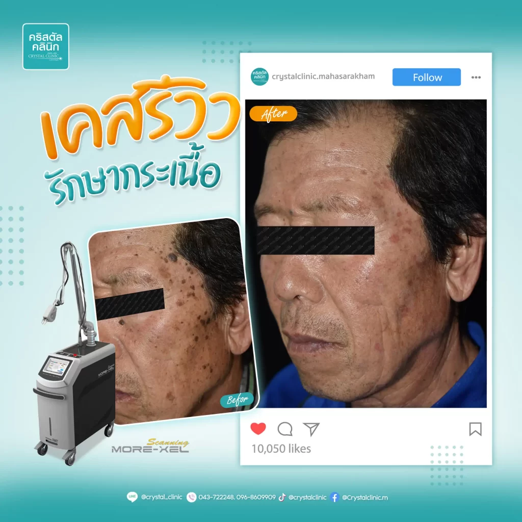 CO2 Laser กำจัดกระเนื้อ คริสตัลคลินิก มหาสารคาม CO2 Laser กำจัดกระเนื้อ คริสตัลคลินิก มหาสารคาม