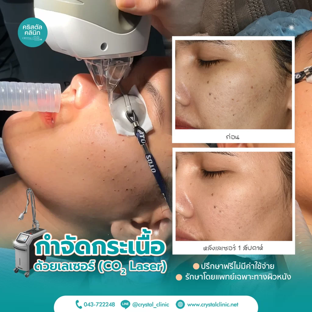 CO2 Laser รักษากระเนื้อ คริสตัลคลินิก มหาสารคาม CO2 Laser รักษากระเนื้อ คริสตัลคลินิก มหาสารคาม