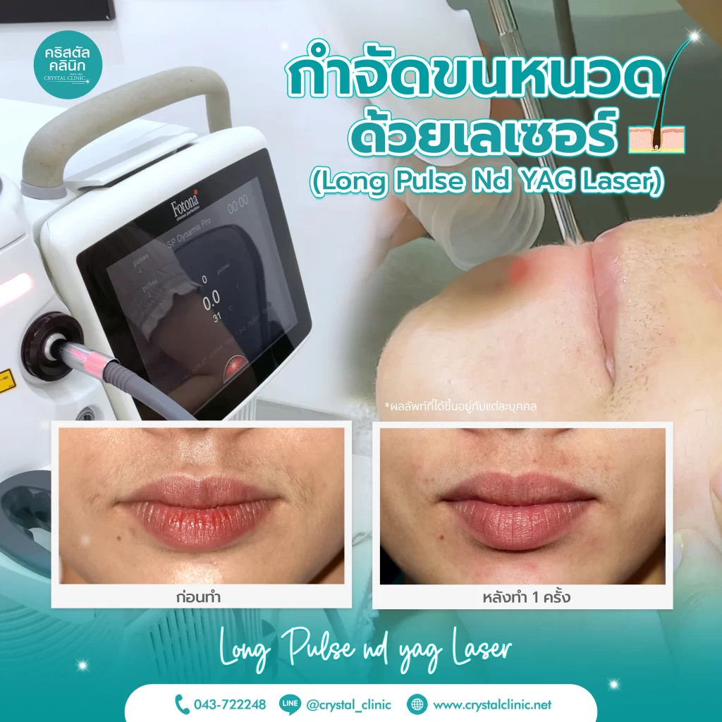 Long Pulse ND YAG Laser กำจัดขนหนวดด้วยเลเซอร์ คริสตัลคลินิก มหาสารคาม Long Pulse ND YAG Laser กำจัดขนหนวดด้วยเลเซอร์ คริสตัลคลินิก มหาสารคาม