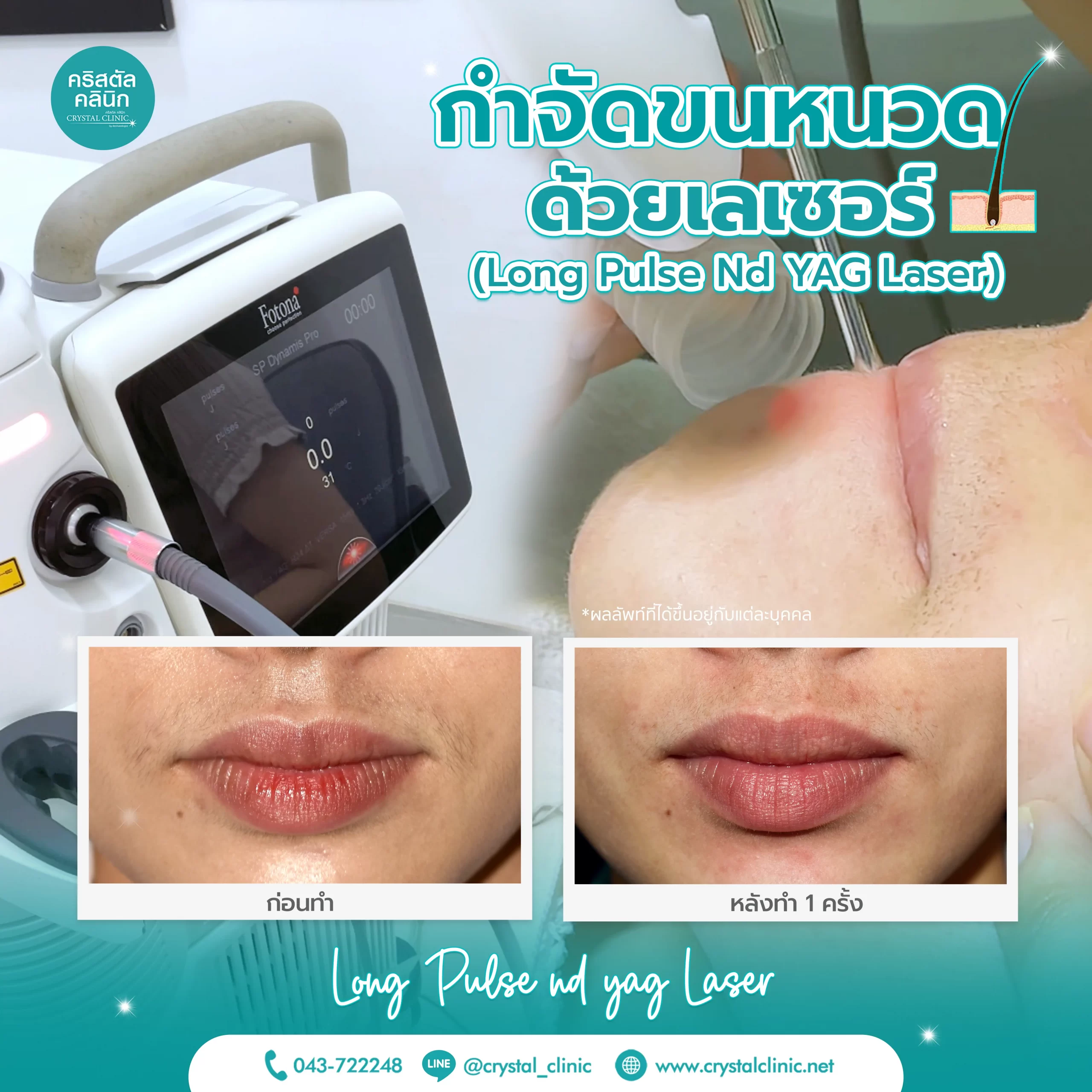 Long Pulse ND YAG Laser กำจัดขนหนวดด้วยเลเซอร์ คริสตัลคลินิก มหาสารคาม