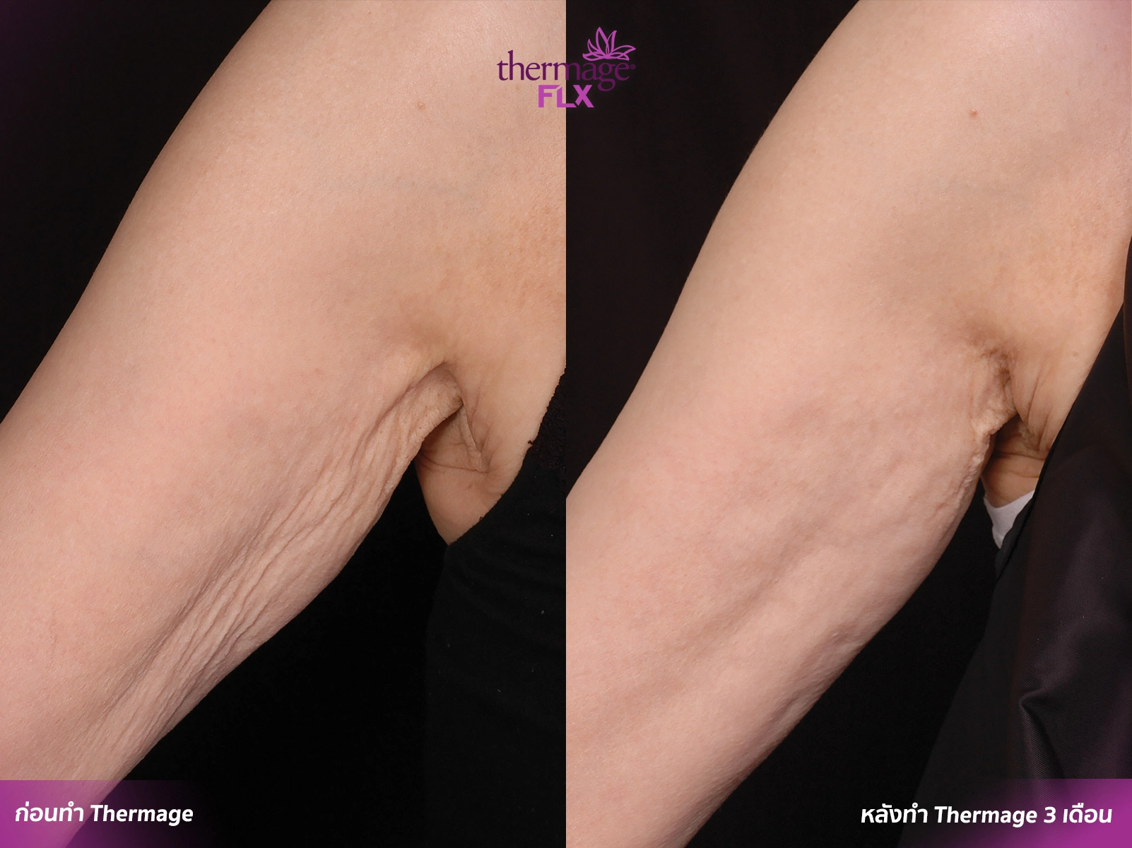 Thermage FLX เทคโนโลยียกกระชับ สลายไขมัน ลดแก้มเหนียง ลำตัว