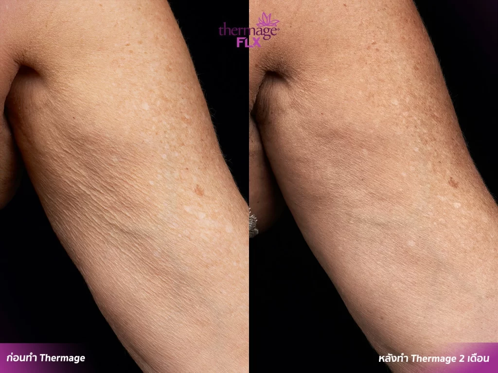 Thermage FLX เทคโนโลยียกกระชับ สลายไขมัน ลดแก้มเหนียง ลำตัว