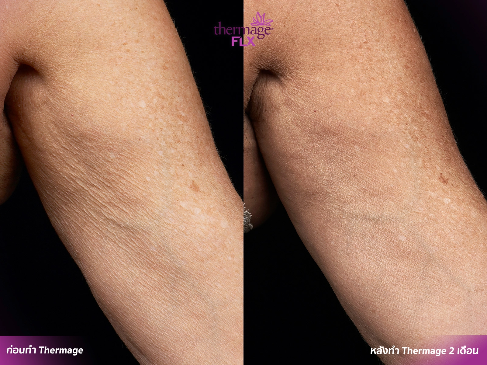Thermage FLX เทคโนโลยียกกระชับ สลายไขมัน ลดแก้มเหนียง ลำตัว