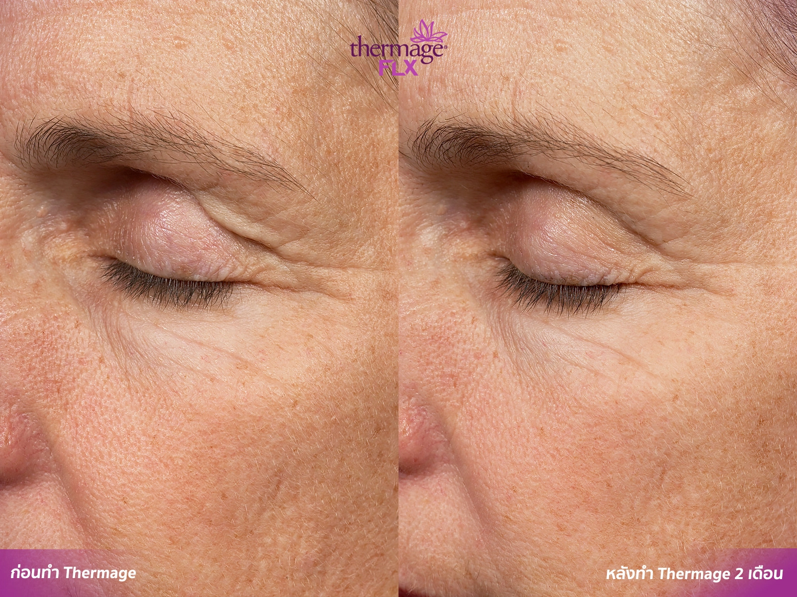 Thermage FLX เทคโนโลยียกกระชับ สลายไขมัน ลดแก้มเหนียง
