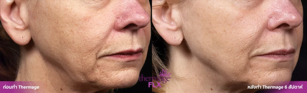 Thermage FLX เทคโนโลยียกกระชับ สลายไขมัน ลดแก้มเหนียง ลำตัว