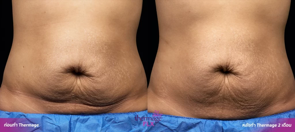 BA thermage 15