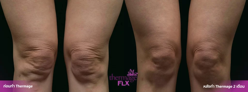 BA thermage 16