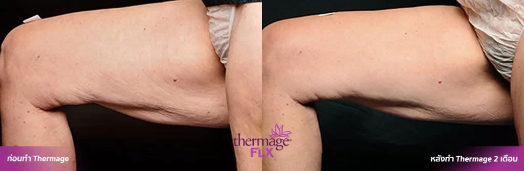 Thermage FLX เทคโนโลยียกกระชับ สลายไขมัน ลดแก้มเหนียง ลำตัว