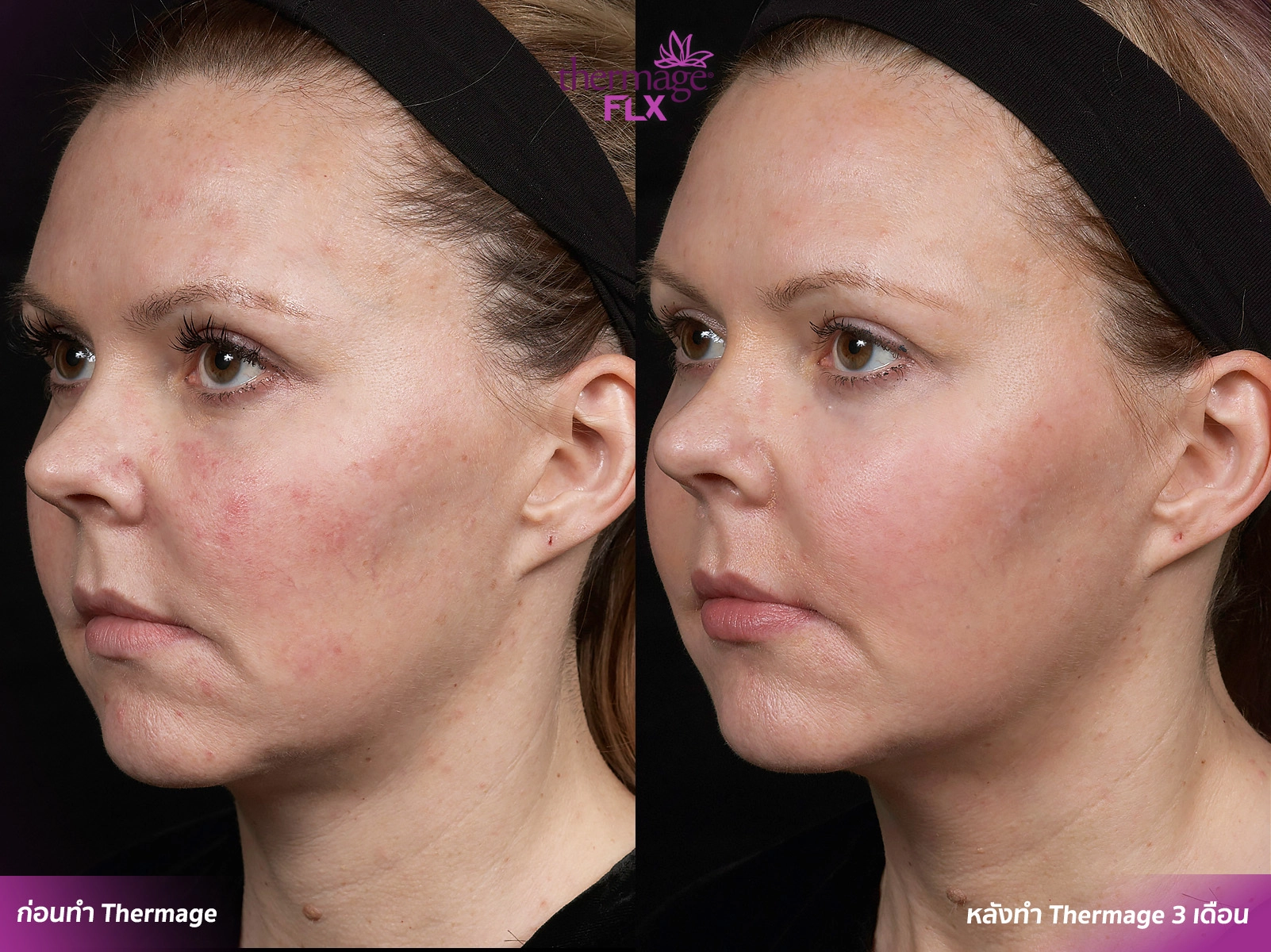 Thermage FLX เทคโนโลยียกกระชับ สลายไขมัน ลดแก้มเหนียง