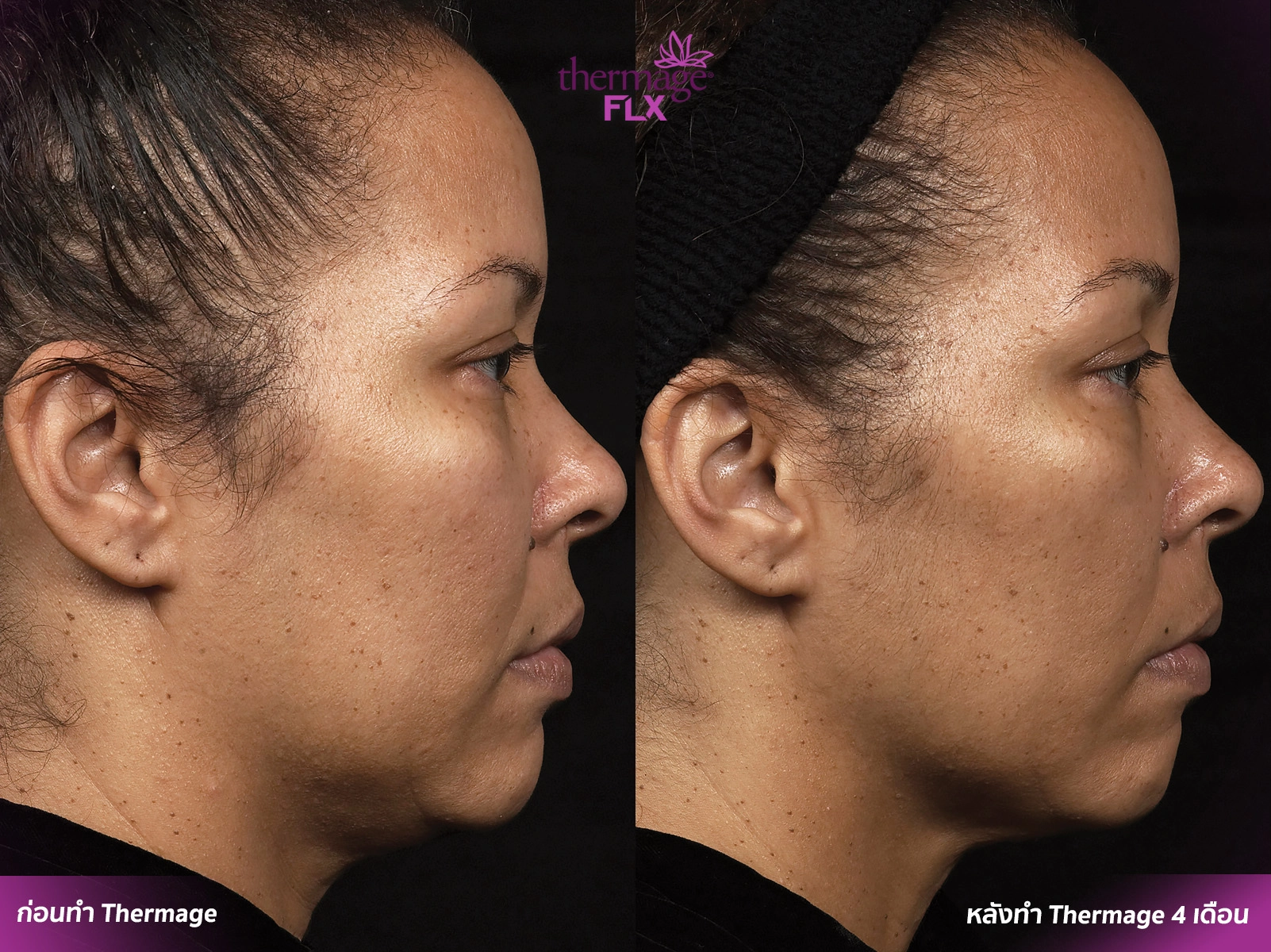 Thermage FLX เทคโนโลยียกกระชับ สลายไขมัน ลดแก้มเหนียง