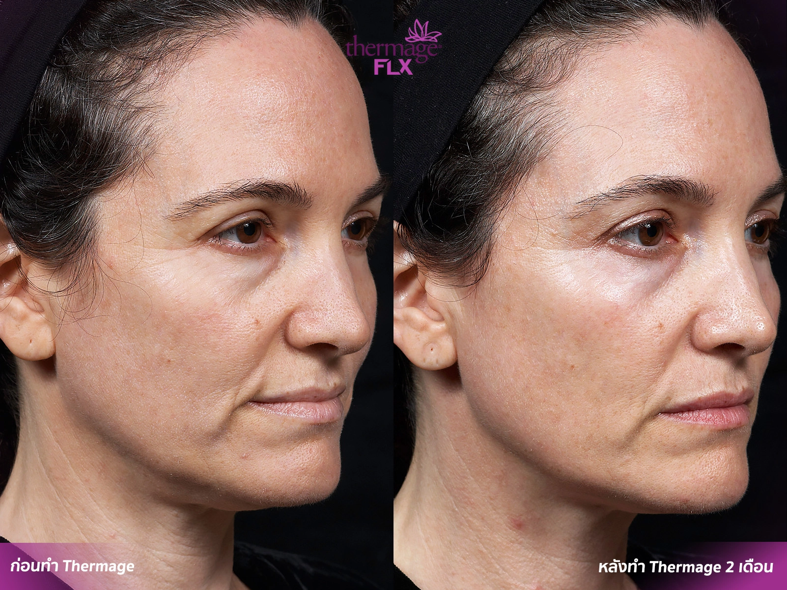 Thermage FLX เทคโนโลยียกกระชับ สลายไขมัน ลดแก้มเหนียง