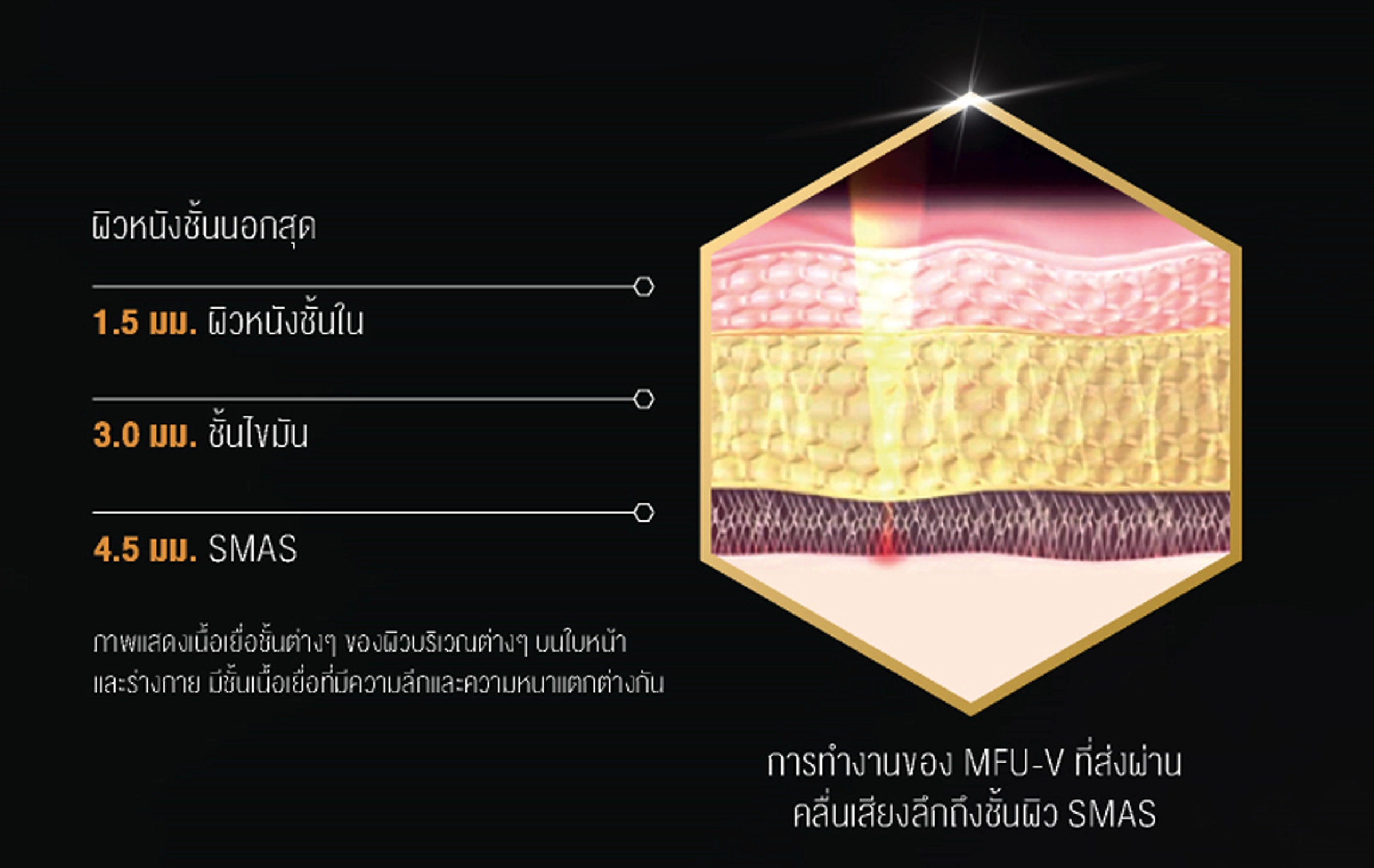 การทำงานของ Ulthera MFU-V ที่ส่งผ่านคลื่นเสียงลึกถึงชั้นผิว SMAS การทำงานของ Ulthera MFU-V ที่ส่งผ่านคลื่นเสียงลึกถึงชั้นผิว SMAS