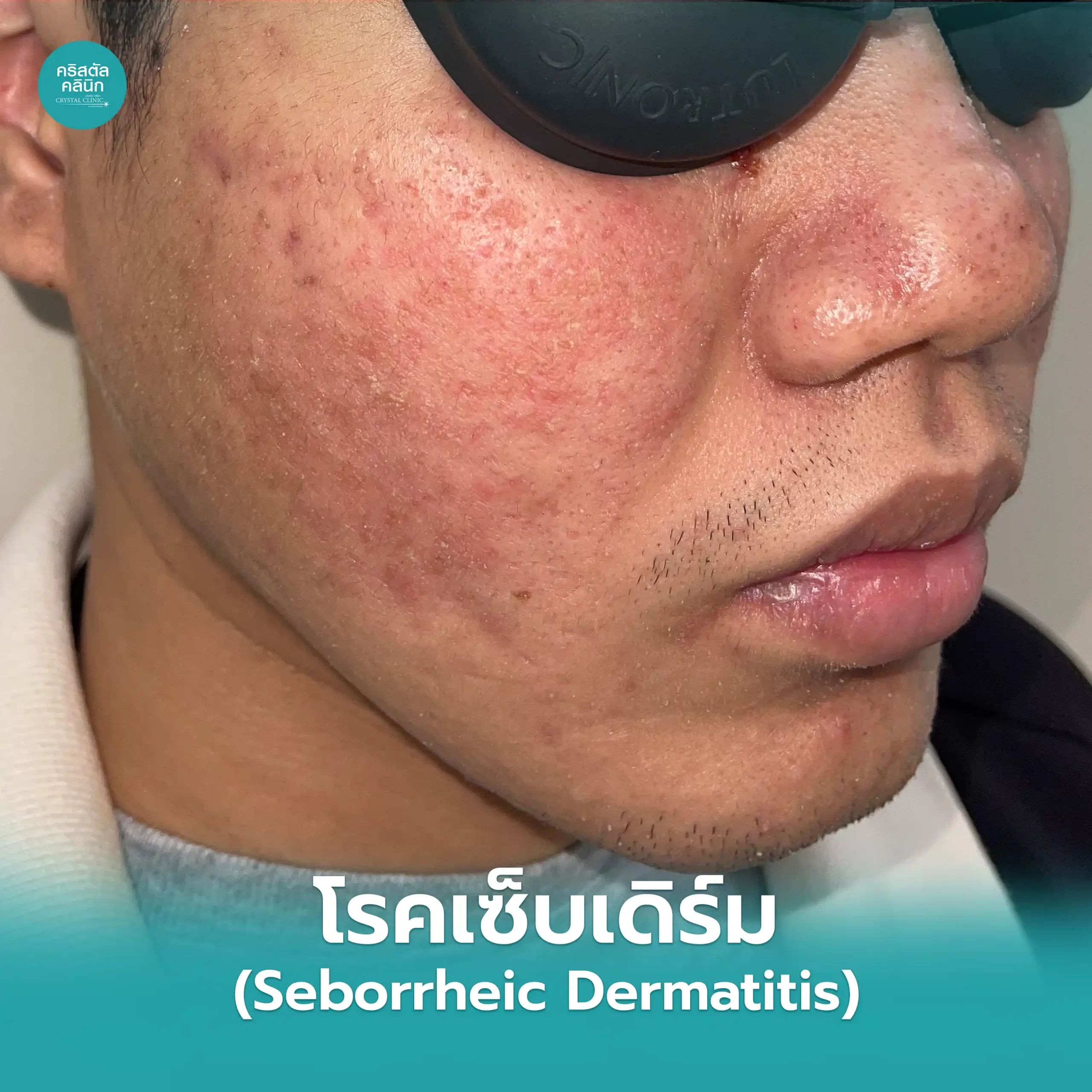 โรคเซ็บเดิร์ม (Seborrheic Dermatitis)