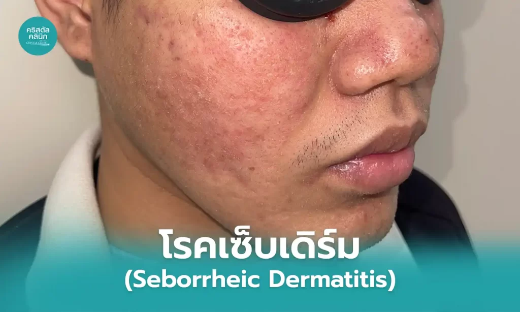 โรคเซ็บเดิร์ม (Seborrheic Dermatitis) โดยนายแพทย์สรรญชัย สมบัติไหมไทย โรคเซ็บเดิร์ม (Seborrheic Dermatitis) โดยนายแพทย์สรรญชัย สมบัติไหมไทย