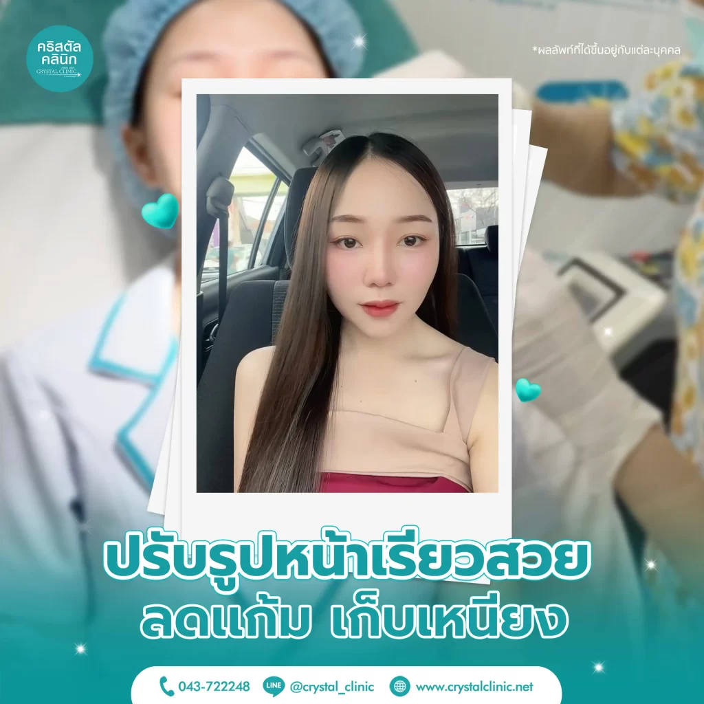 เมโสแฟต สลายไขมัน แก้ม เหนียง เมโสแฟต สลายไขมัน แก้ม เหนียง