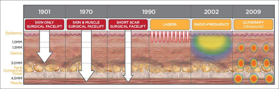 ภาพแสดงผิวชั้น SMAS ระดับชั้นที่ Ultherapy #สวยด้วยเสียง เข้าปฏิบัติการ ภาพแสดงผิวชั้น SMAS ระดับชั้นที่ Ultherapy