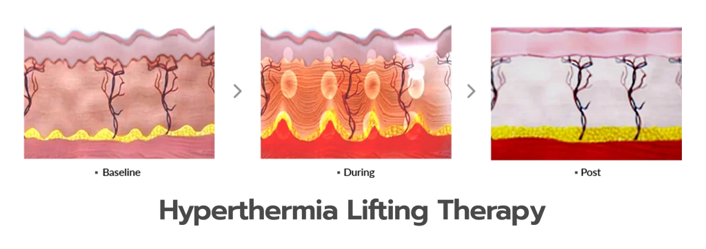 Hyperthermia Lifting Therapy Ultraformer III Hyperthermia Lifting Therapy Ultraformer III