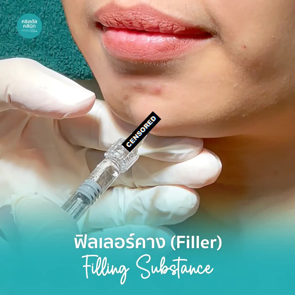 ฉีดฟิลเลอร์คาง (Filler) คริสตัลคลินิก มหาสารคาม