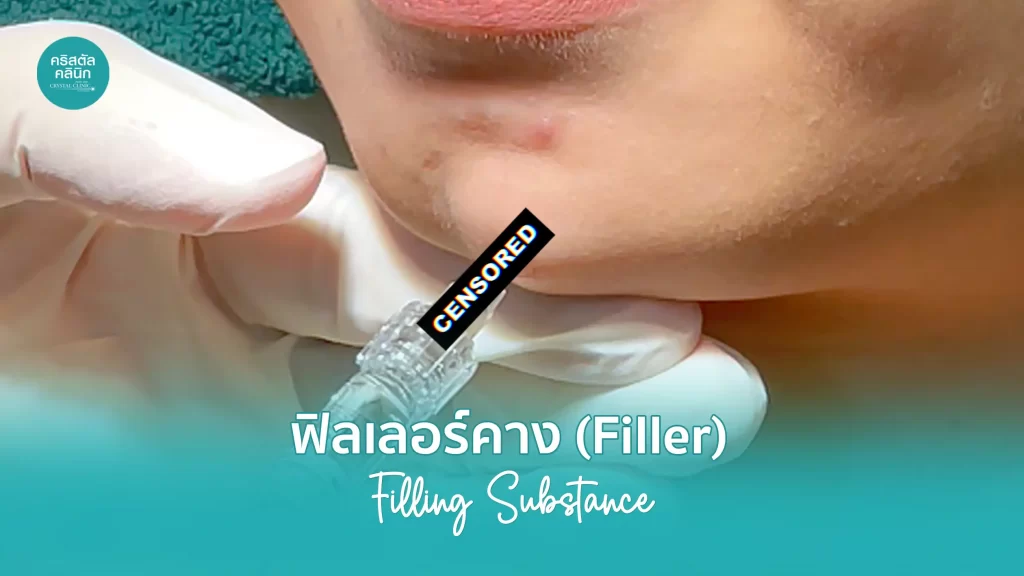 ฉีดฟิลเลอร์คาง (Filler) คริสตัลคลินิก มหาสารคาม ฉีดฟิลเลอร์คาง (Filler) คริสตัลคลินิก มหาสารคาม