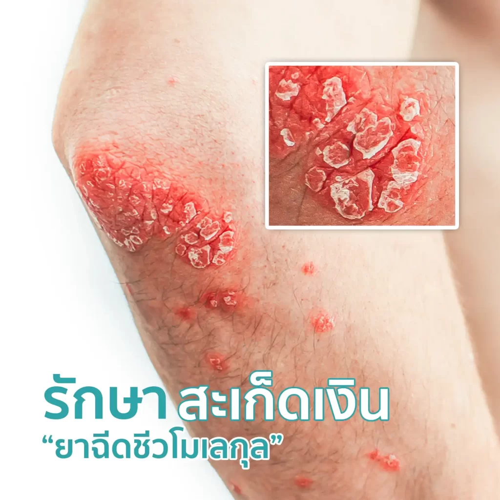 รักษาสะเก็ดเงิน ยาฉีดชีวโมเลกุล คริสตัลคลินิก มหาสารคาม