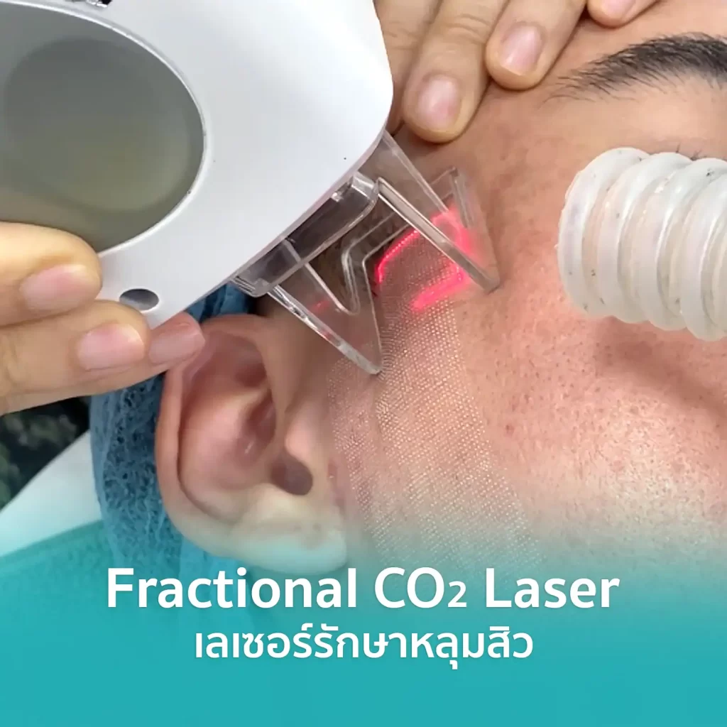 รักษาหลุมสิวด้วยเลเซอร์ Fractional CO2 Laser