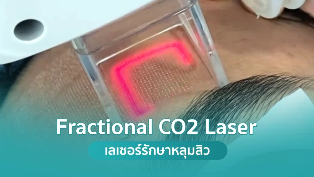 รักษาหลุมสิวด้วยเลเซอร์ Fractional CO2 Laser คริสตัลคลินิก มหาสารคาม รักษาหลุมสิวด้วยเลเซอร์ Fractional CO2 Laser คริสตัลคลินิก มหาสารคาม