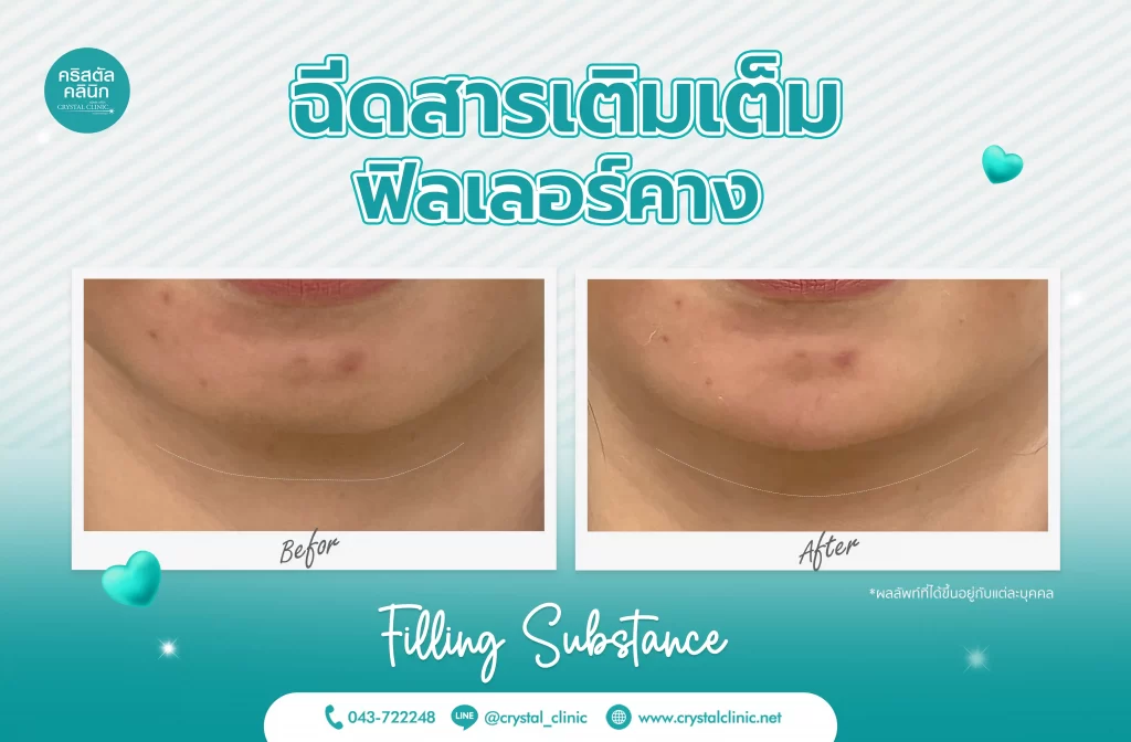รีวิวฉีดฟิลเลอร์คาง (Filler) คริสตัลคลินิก มหาสารคาม 1 รีวิวฉีดฟิลเลอร์คาง (Filler) คริสตัลคลินิก มหาสารคาม 1