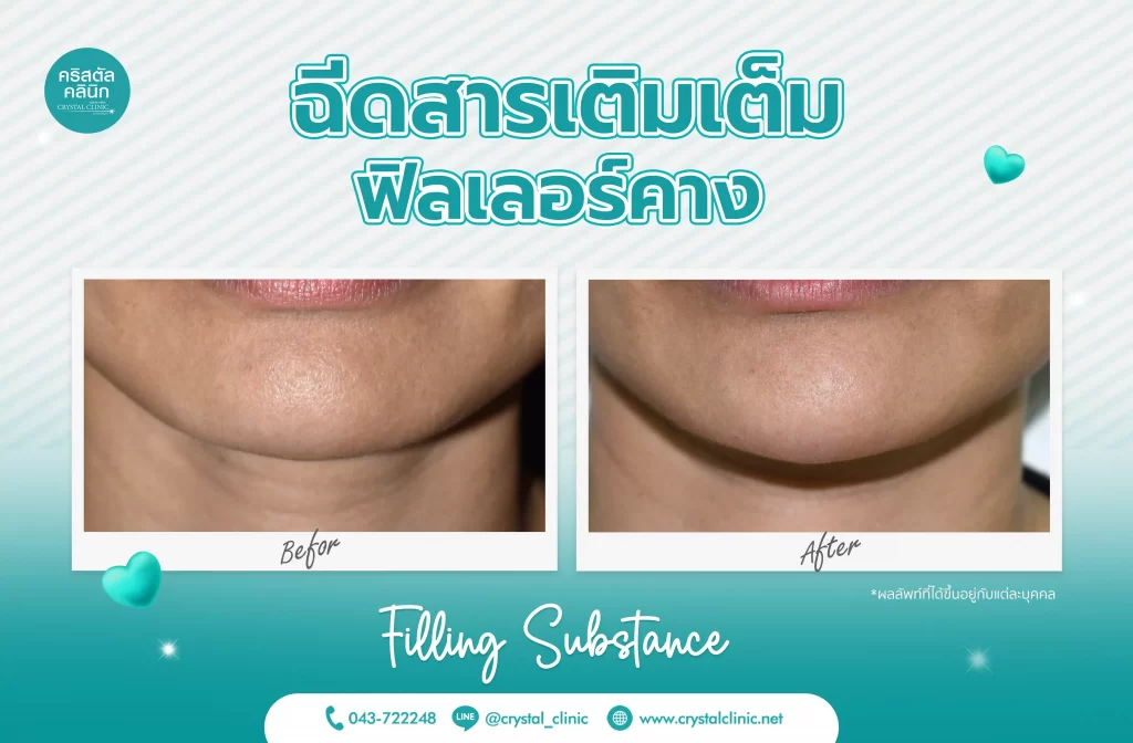 รีวิวฉีดฟิลเลอร์คาง (Filler) คริสตัลคลินิก มหาสารคาม 2 รีวิวฉีดฟิลเลอร์คาง (Filler) คริสตัลคลินิก มหาสารคาม 2