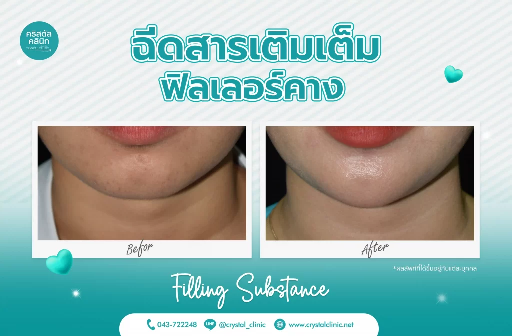 รีวิวฉีดฟิลเลอร์คาง (Filler) คริสตัลคลินิก มหาสารคาม 3 รีวิวฉีดฟิลเลอร์คาง (Filler) คริสตัลคลินิก มหาสารคาม 3