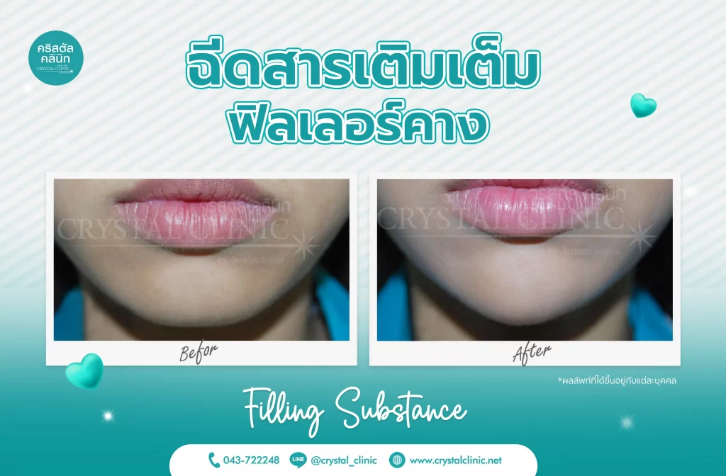 รีวิวฉีดฟิลเลอร์คาง (Filler) คริสตัลคลินิก มหาสารคาม 4 รีวิวฉีดฟิลเลอร์คาง (Filler) คริสตัลคลินิก มหาสารคาม 4